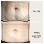 Dermaclara Large Body Patch - Pregnancy Stretch Mark Prevention & Removal, C Section Cover Up Belly Scar, Maternity Skincare, Silicone Gel Sheet, Reusable up to 30 Times - 2 Patches & Patch Cleanser