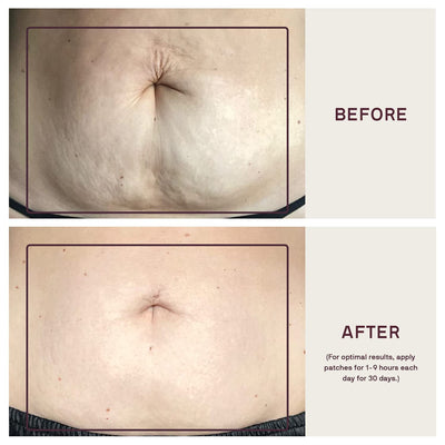 Dermaclara Large Body Patch - Pregnancy Stretch Mark Prevention & Removal, C Section Cover Up Belly Scar, Maternity Skincare, Silicone Gel Sheet, Reusable up to 30 Times - 2 Patches & Patch Cleanser
