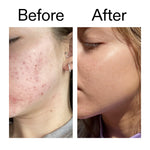 The INKEY List 10% Niacinamide Serum, Lightweight Oil Control Serum Helps with Blemishes and Appearance of Redness, Hydrating 1% Hyaluronic Acid 30ml, 1 fl oz