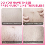 Stretch Marks Removal, Safe and Gentle Formula Stretch Mark Cream for Pregnancy, Pregnancy Stretch Mark Prevention Cream, Improve Skin Appearance and Elasticity